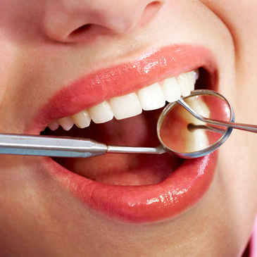 Fissure Sealants in Teeth